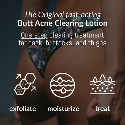 Butt Acne Clearing Lotion ® | 5 OZ