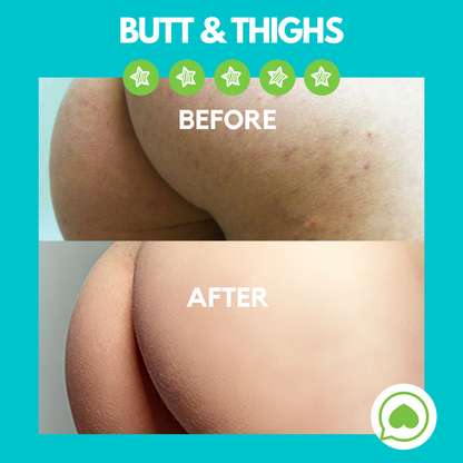 Butt Acne Clearing Lotion ® | Grape 5 OZ