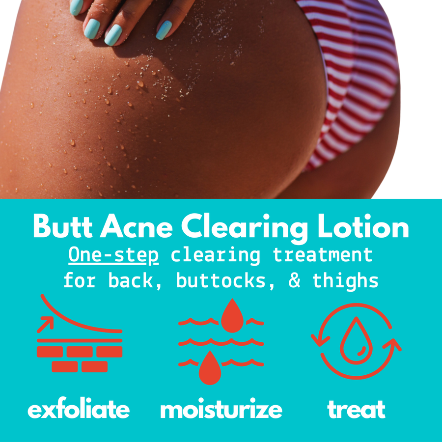 Butt Acne Clearing Lotion ® | 4 oz (113 gr)